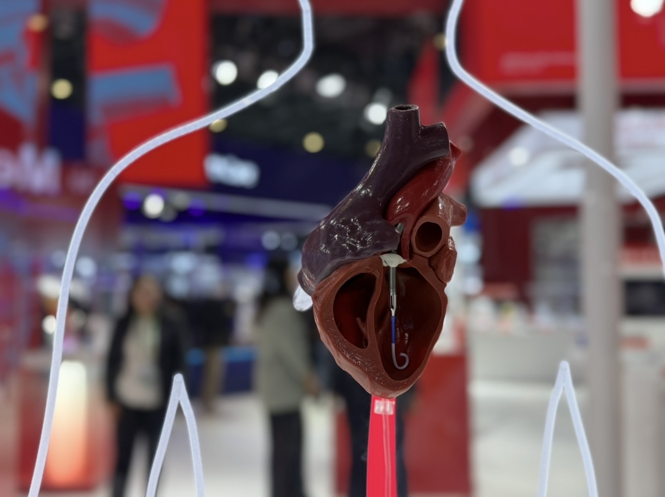 聚焦进博会|进口人工心脏、三尖瓣加速入华,心血管医疗器械赛道活跃